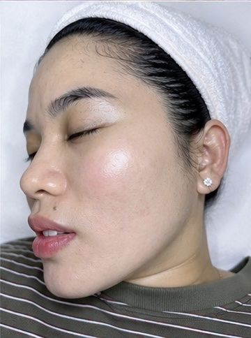 Kết quả khách hàng liệu trình nám