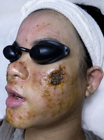 Kết quả khách hàng liệu trình mụn