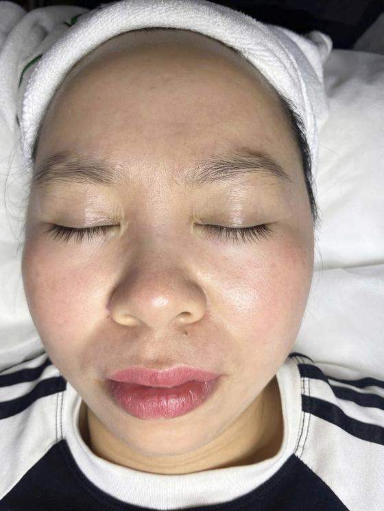Kết quả khách hàng liệu trình nám
