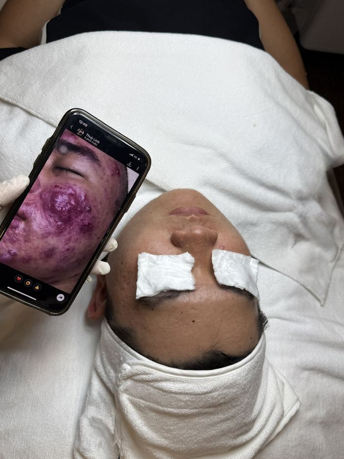 Kết quả khách hàng liệu trình mụn