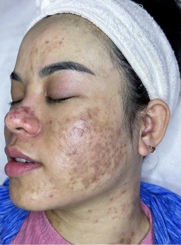 Kết quả khách hàng liệu trình mụn