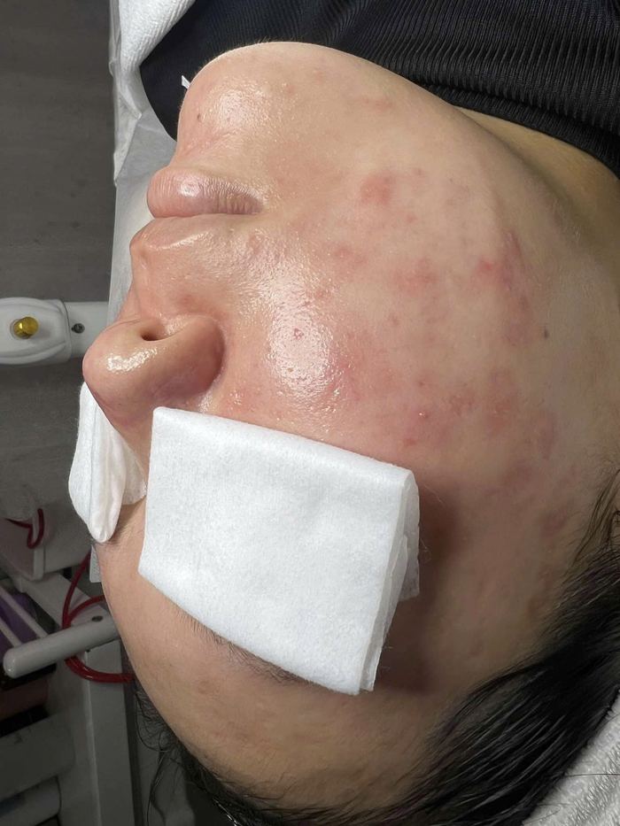 Kết quả khách hàng liệu trình mụn