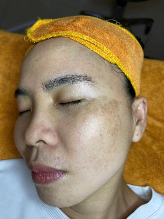 Kết quả khách hàng liệu trình nám
