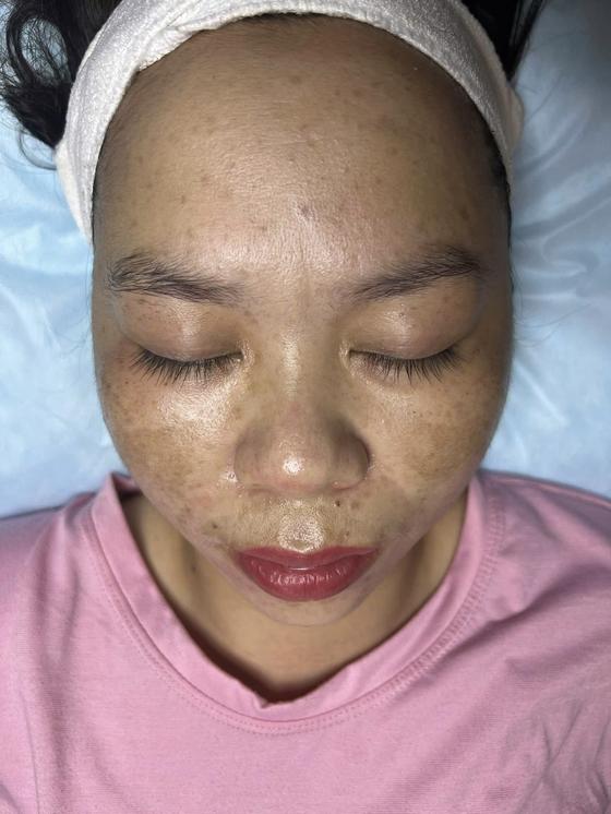Kết quả khách hàng liệu trình nám