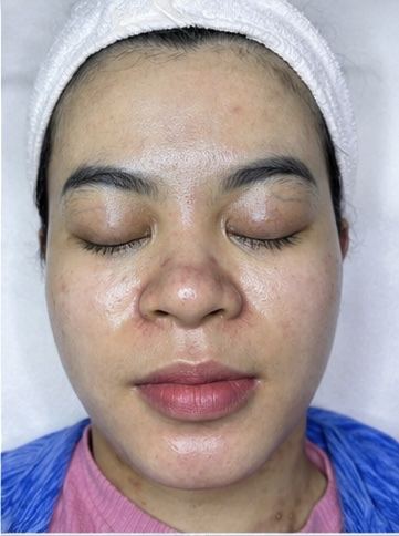 Kết quả khách hàng liệu trình mụn